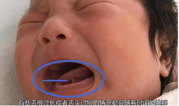 中国式剪绊舌，让多少孩子无辜挨刀？只有在这两种情况下才需要剪