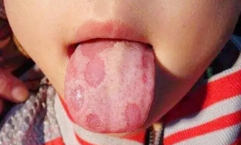 孩子出现“地图舌”，往往预示着身体状况不佳，尽早调理少生病
