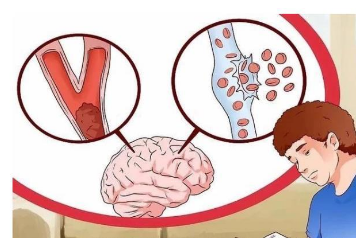 身体出现这4个症状，可能是身体在暗示脑供血不足，还请及时疏通！