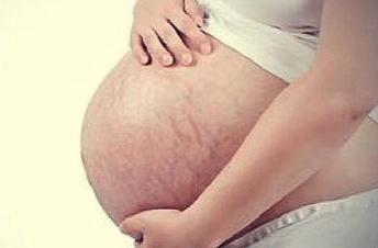 孕期什么样的孕妈不容易长妊娠纹？