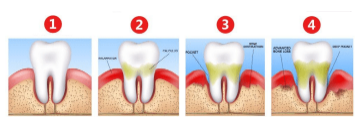 牙周炎能治好吗？